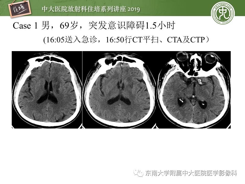 【PPT】急性缺血性脑卒中的影像评估