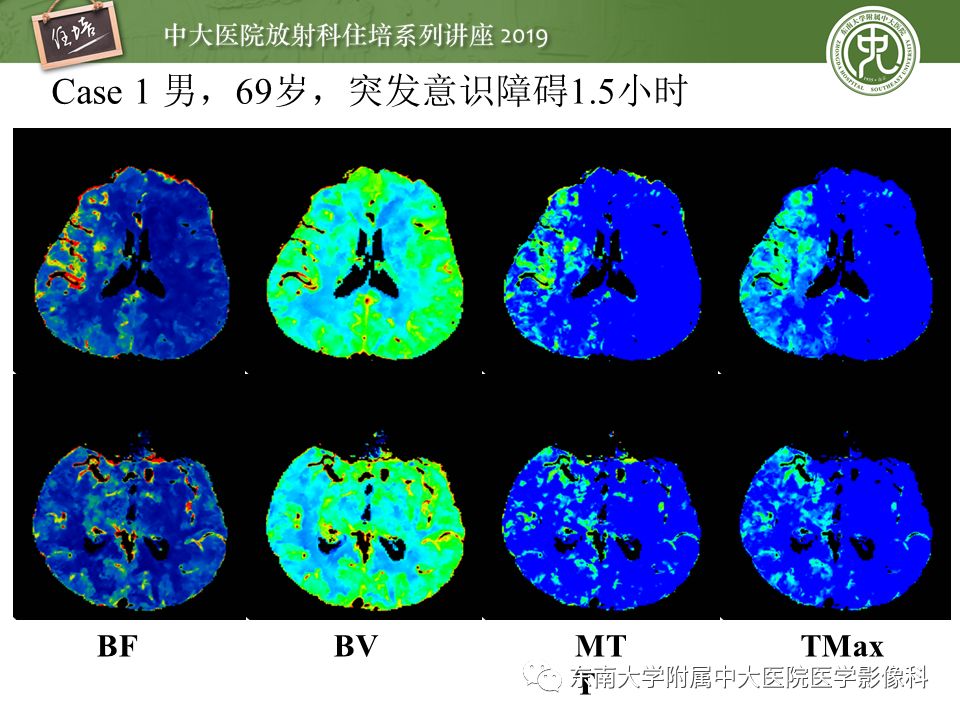 【PPT】急性缺血性脑卒中的影像评估