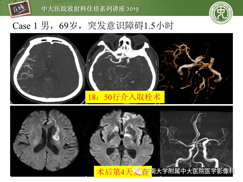【PPT】急性缺血性脑卒中的影像评估