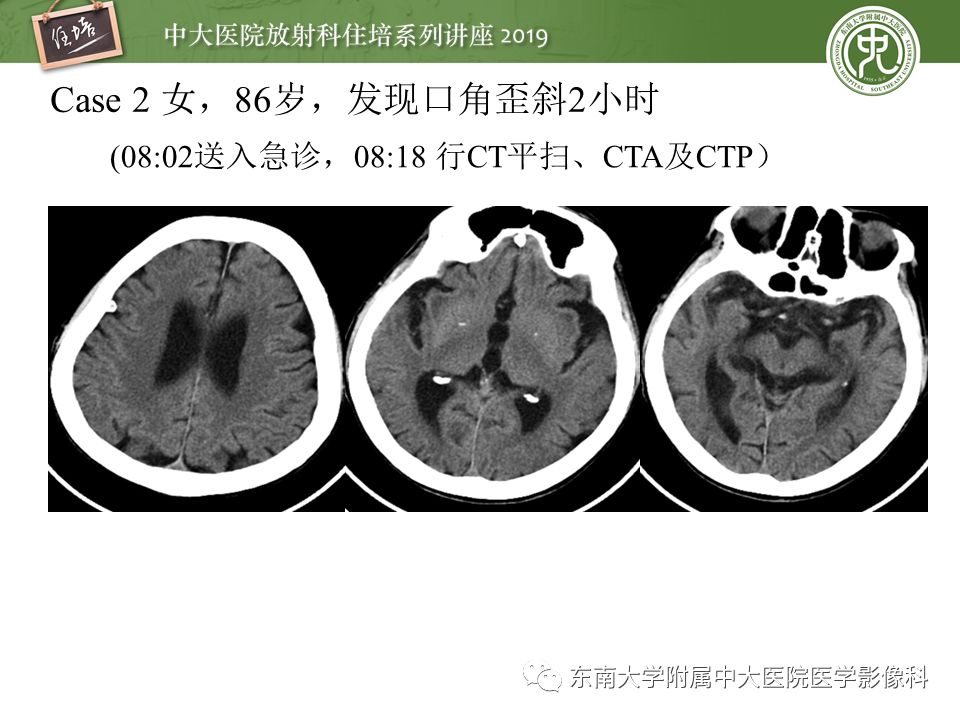 【PPT】急性缺血性脑卒中的影像评估