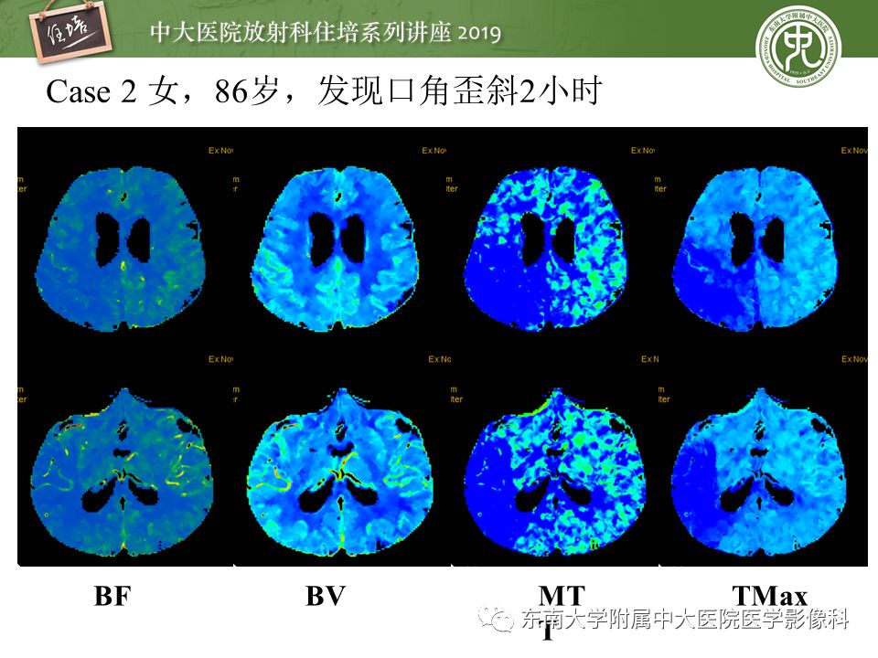 【PPT】急性缺血性脑卒中的影像评估