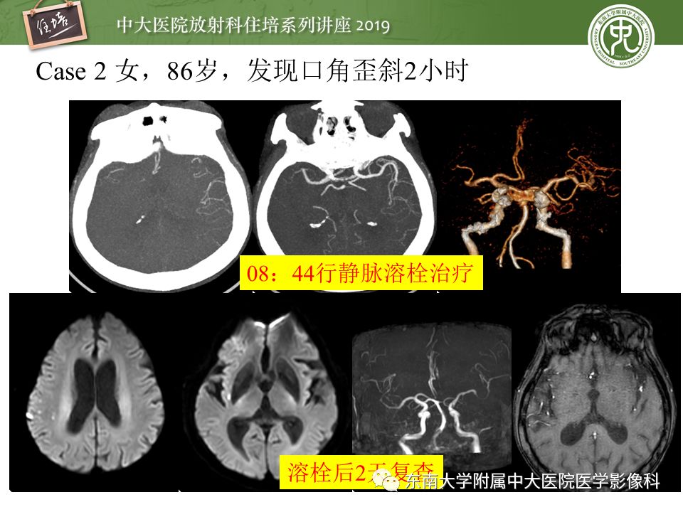 【PPT】急性缺血性脑卒中的影像评估