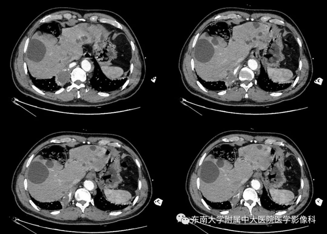 【病例】肺隔离症1例CT影像