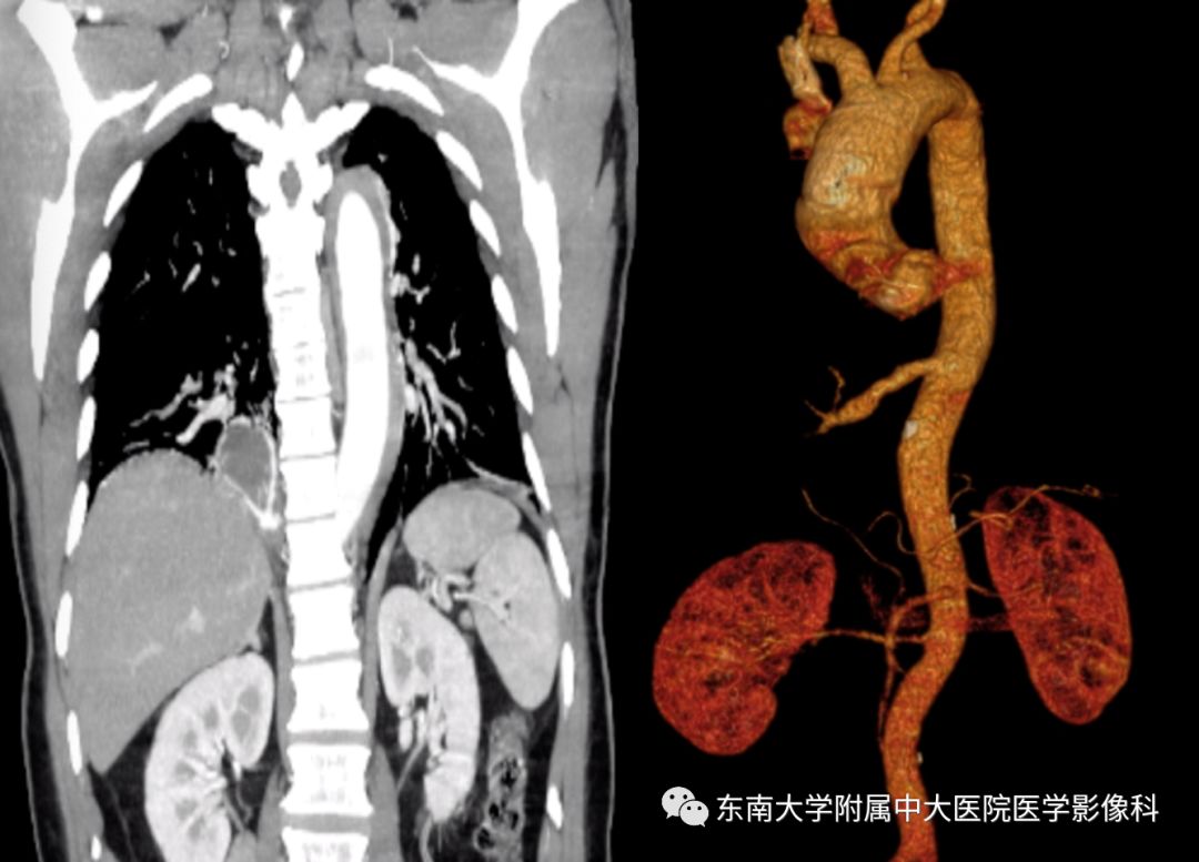 【病例】肺隔离症1例CT影像