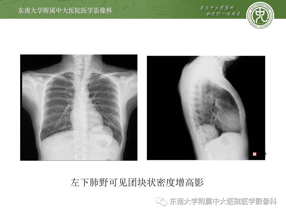 【病例】肺隔离症1例CT影像