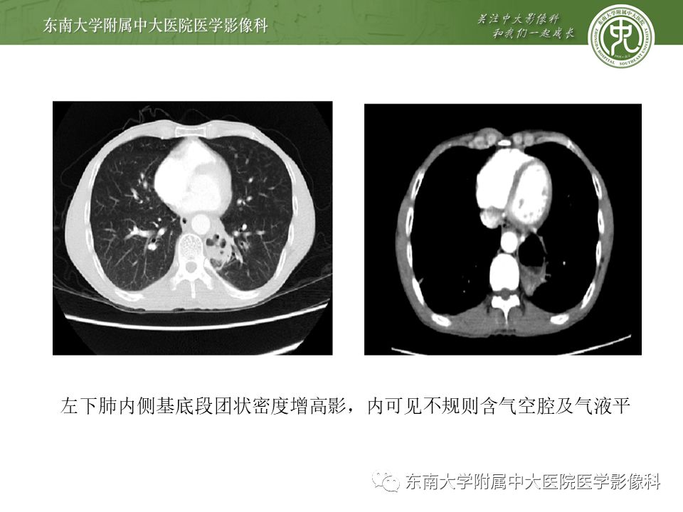 【病例】肺隔离症1例CT影像