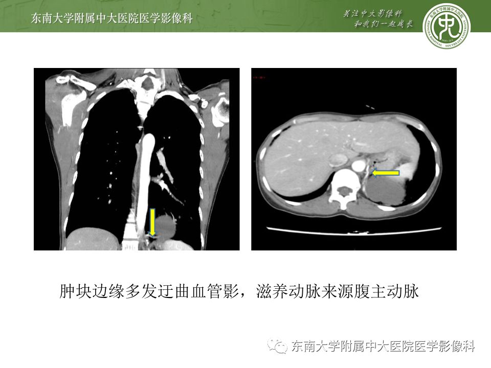【病例】肺隔离症1例CT影像