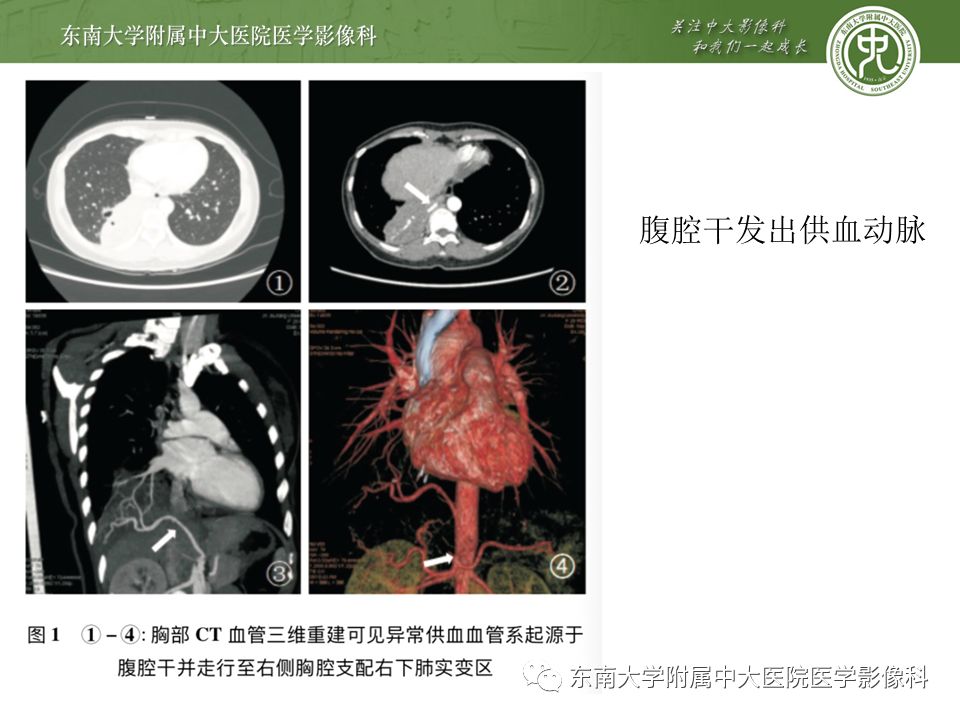 【病例】肺隔离症1例CT影像