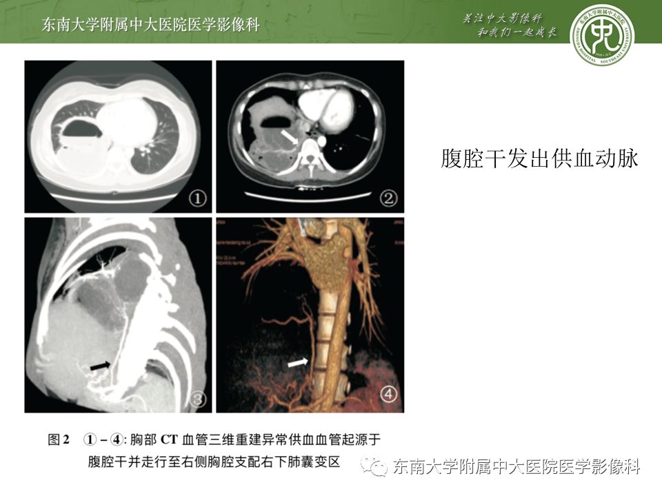 【病例】肺隔离症1例CT影像