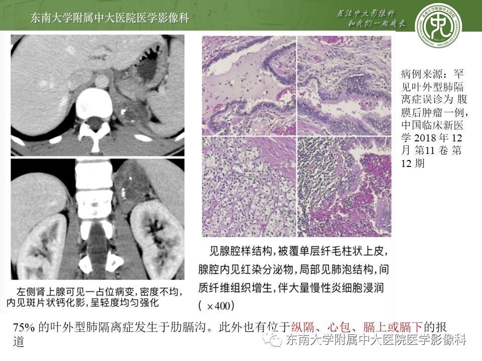 【病例】肺隔离症1例CT影像