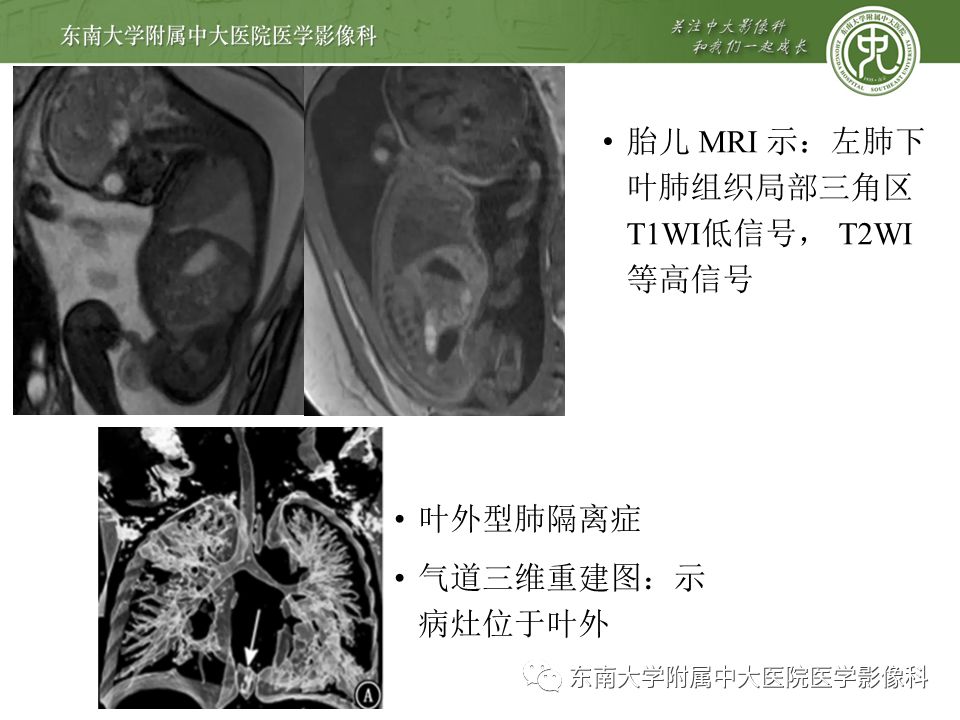 【病例】肺隔离症1例CT影像