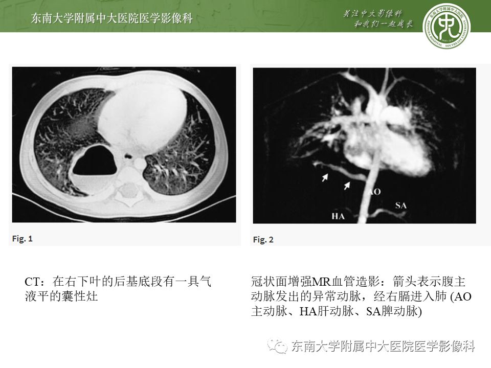 【病例】肺隔离症1例CT影像