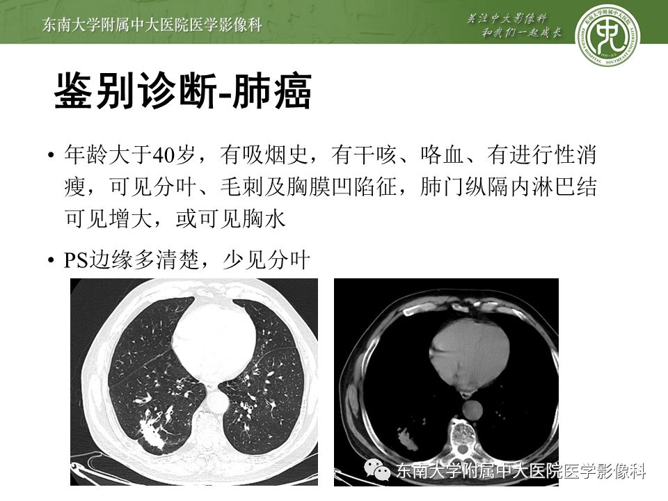 【病例】肺隔离症1例CT影像