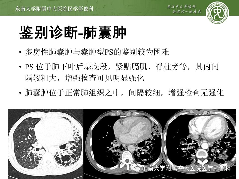 【病例】肺隔离症1例CT影像