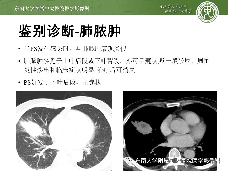 【病例】肺隔离症1例CT影像