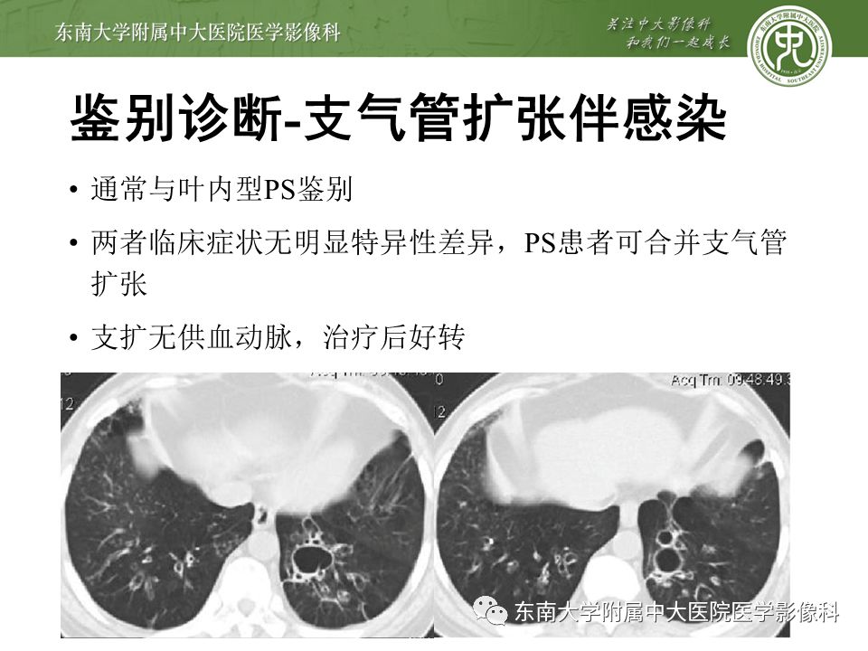 【病例】肺隔离症1例CT影像
