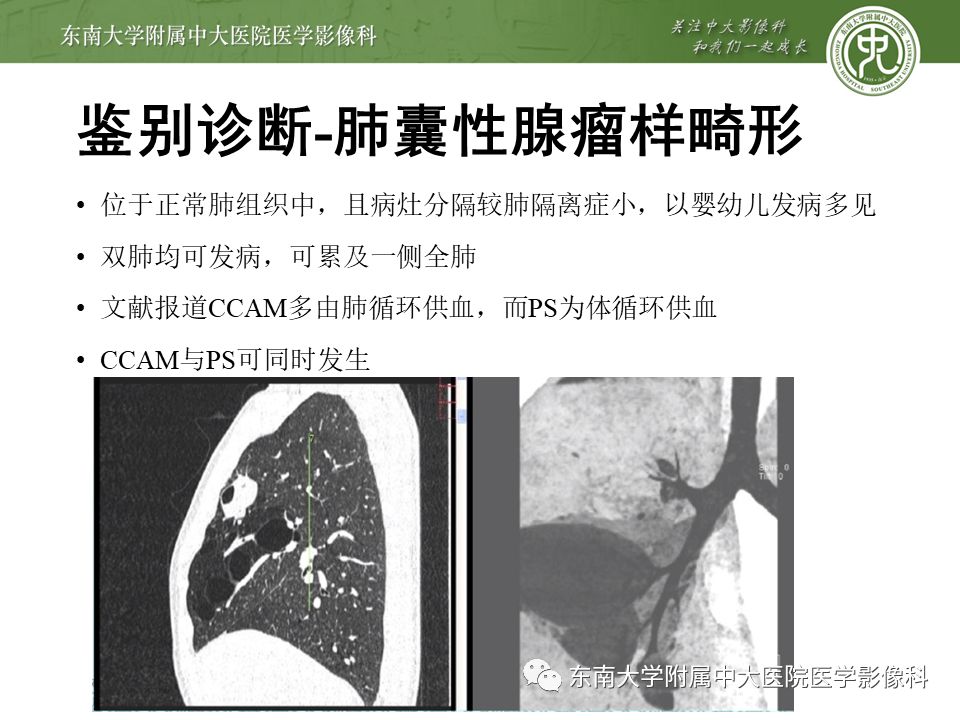 【病例】肺隔离症1例CT影像