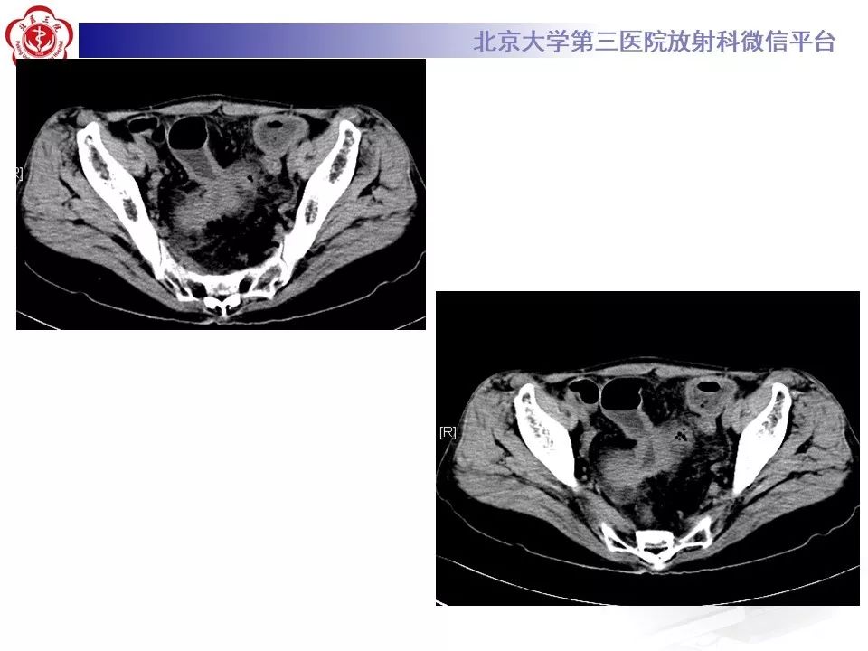 【病例】克罗恩病1例CT影像