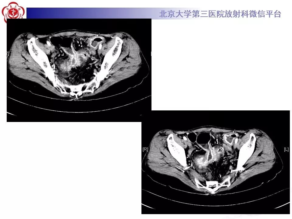 【病例】克罗恩病1例CT影像