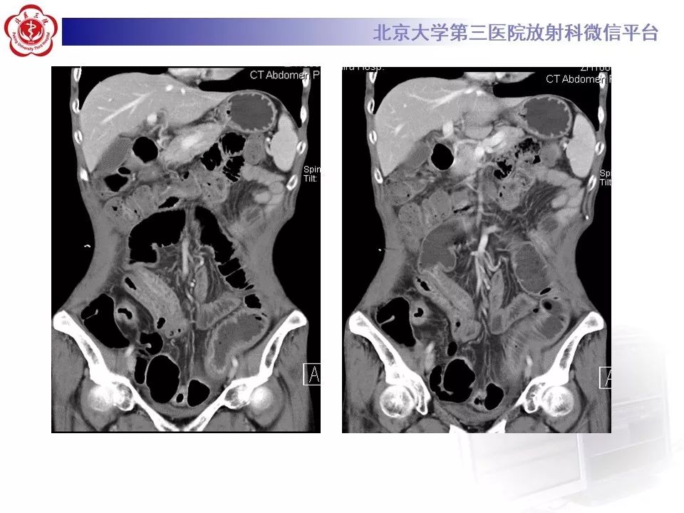 【病例】克罗恩病1例CT影像