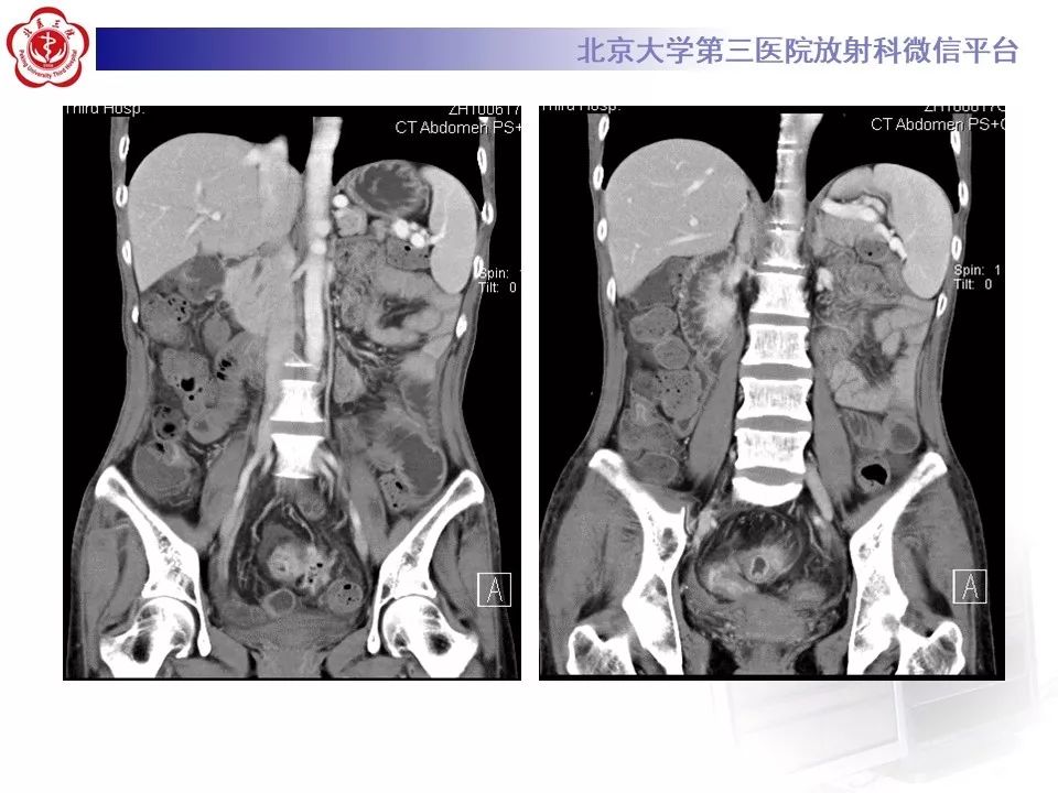 【病例】克罗恩病1例CT影像
