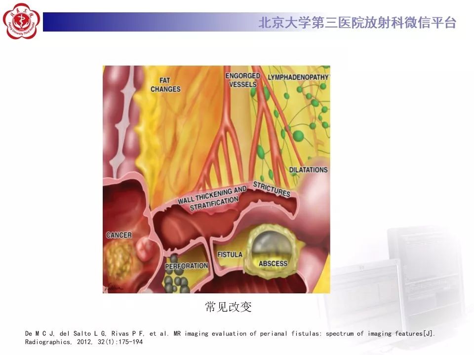 【病例】克罗恩病1例CT影像
