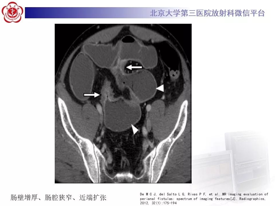 【病例】克罗恩病1例CT影像