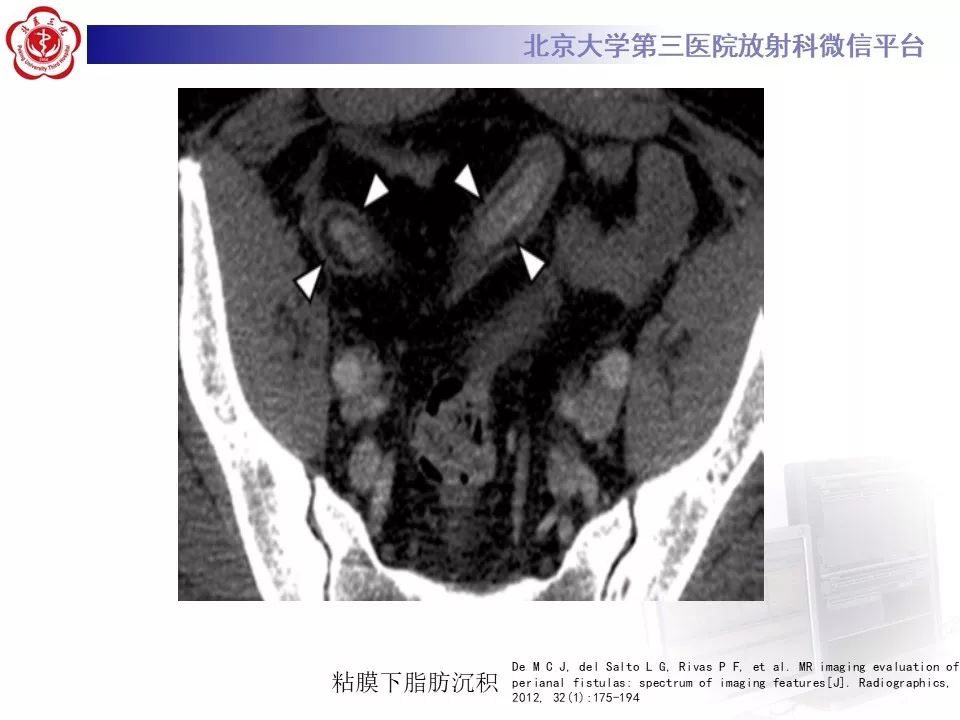 【病例】克罗恩病1例CT影像