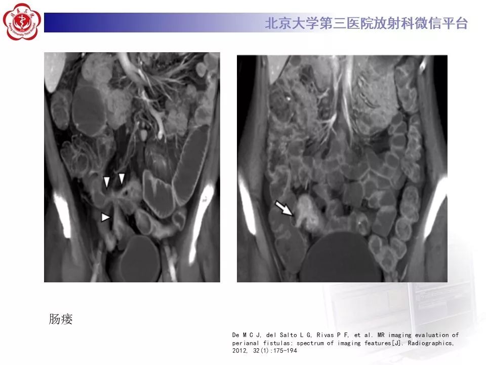 【病例】克罗恩病1例CT影像