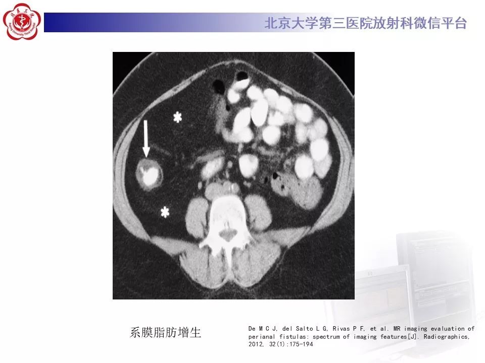 【病例】克罗恩病1例CT影像