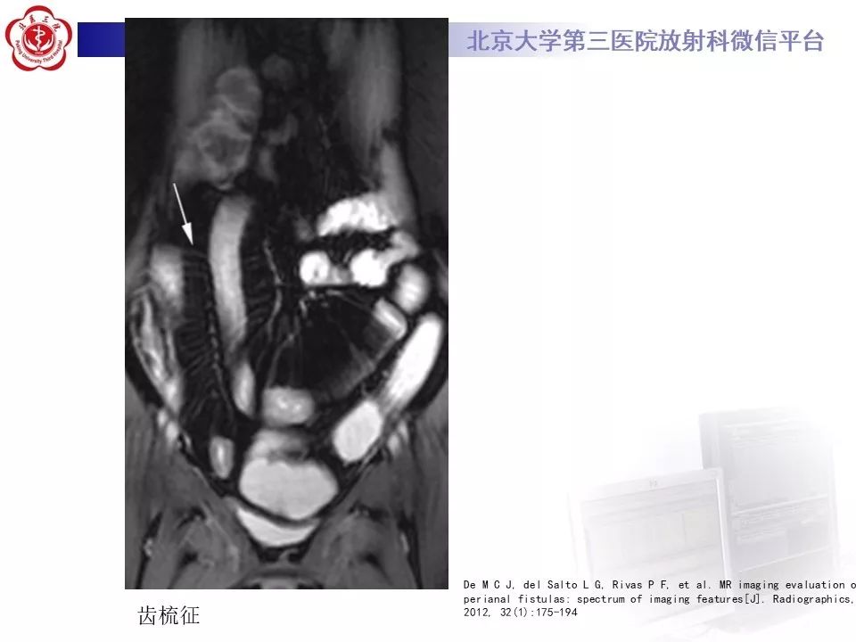 【病例】克罗恩病1例CT影像