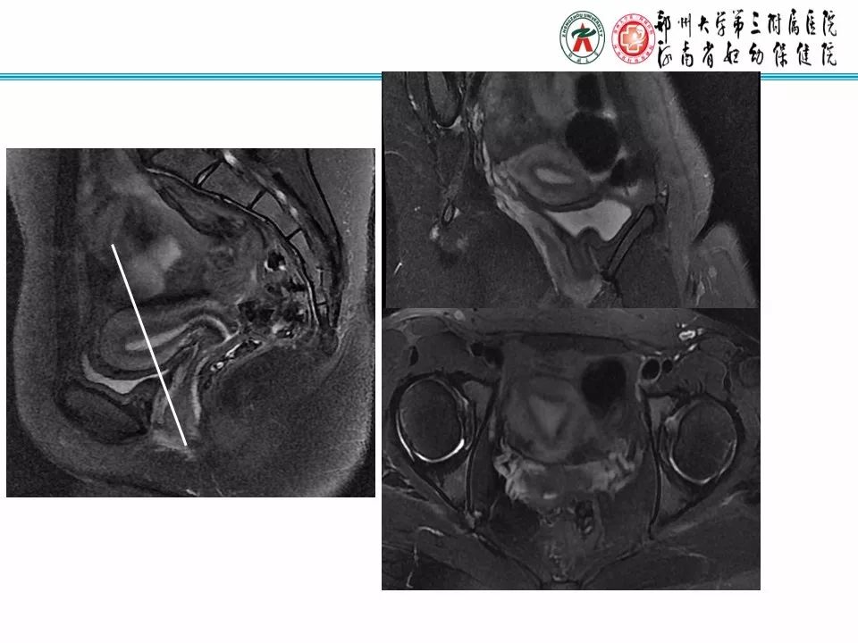【PPT】子宫常见肿瘤的MRI表现
