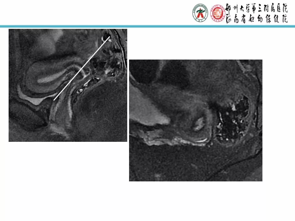 【PPT】子宫常见肿瘤的MRI表现