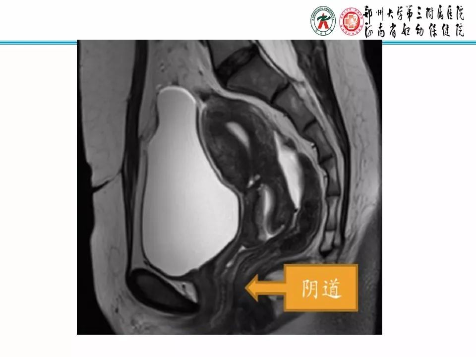 【PPT】子宫常见肿瘤的MRI表现