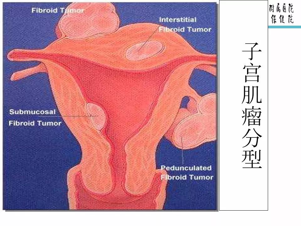 【PPT】子宫常见肿瘤的MRI表现