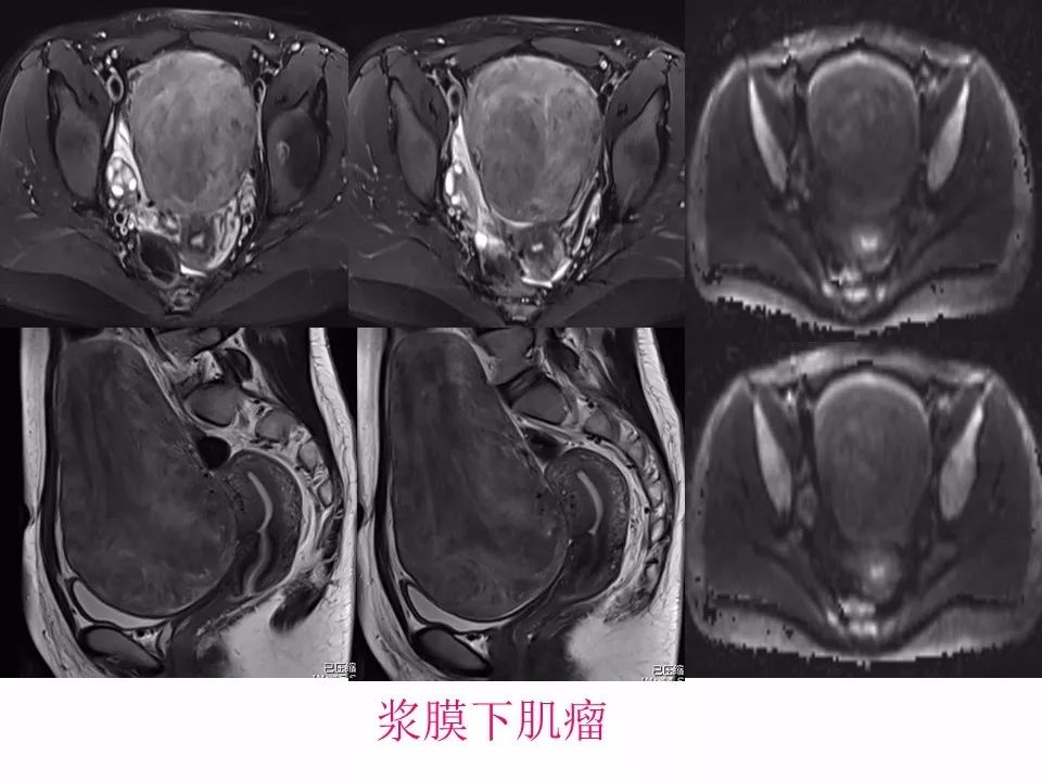 【PPT】子宫常见肿瘤的MRI表现