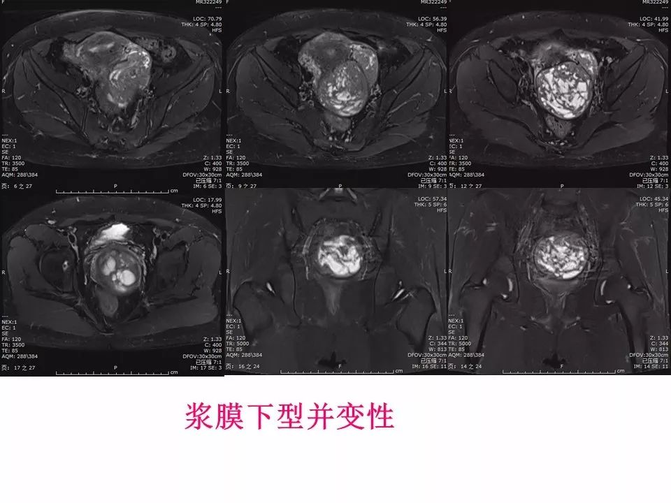 【PPT】子宫常见肿瘤的MRI表现