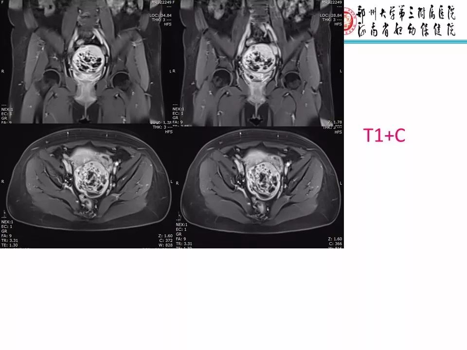 【PPT】子宫常见肿瘤的MRI表现