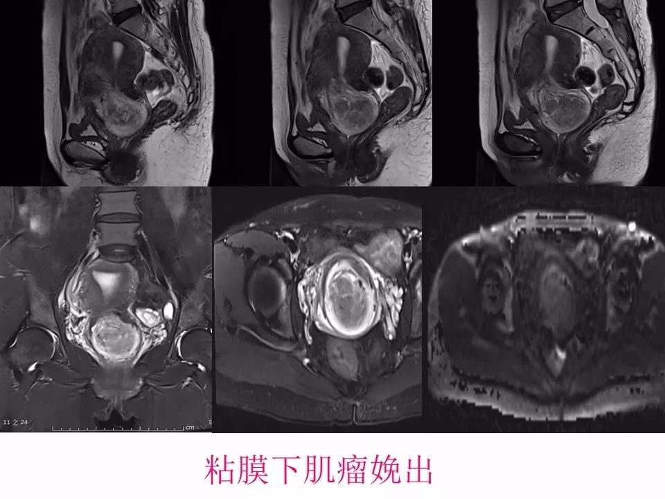 【PPT】子宫常见肿瘤的MRI表现