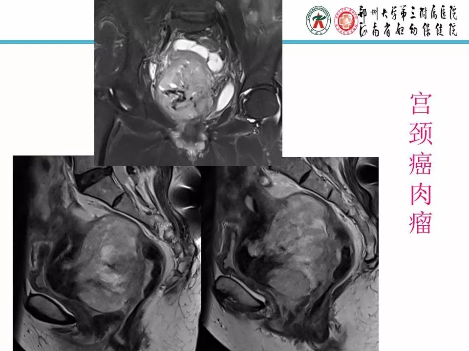 【PPT】子宫常见肿瘤的MRI表现