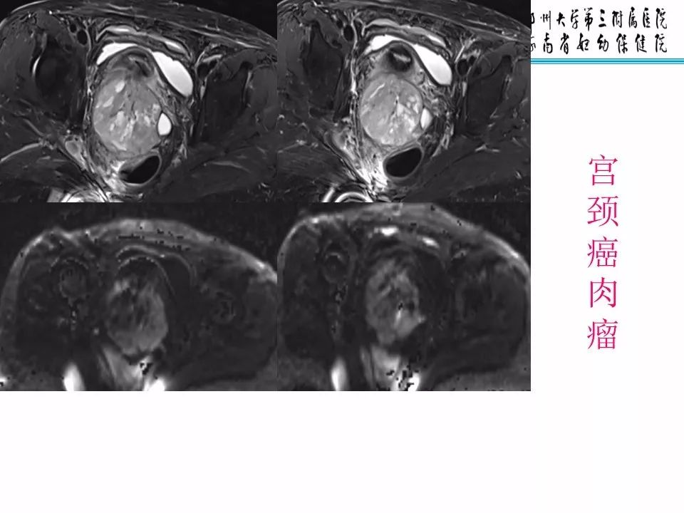 【PPT】子宫常见肿瘤的MRI表现
