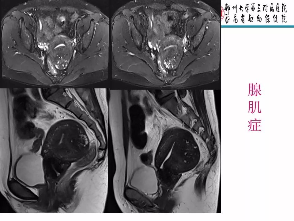 【PPT】子宫常见肿瘤的MRI表现
