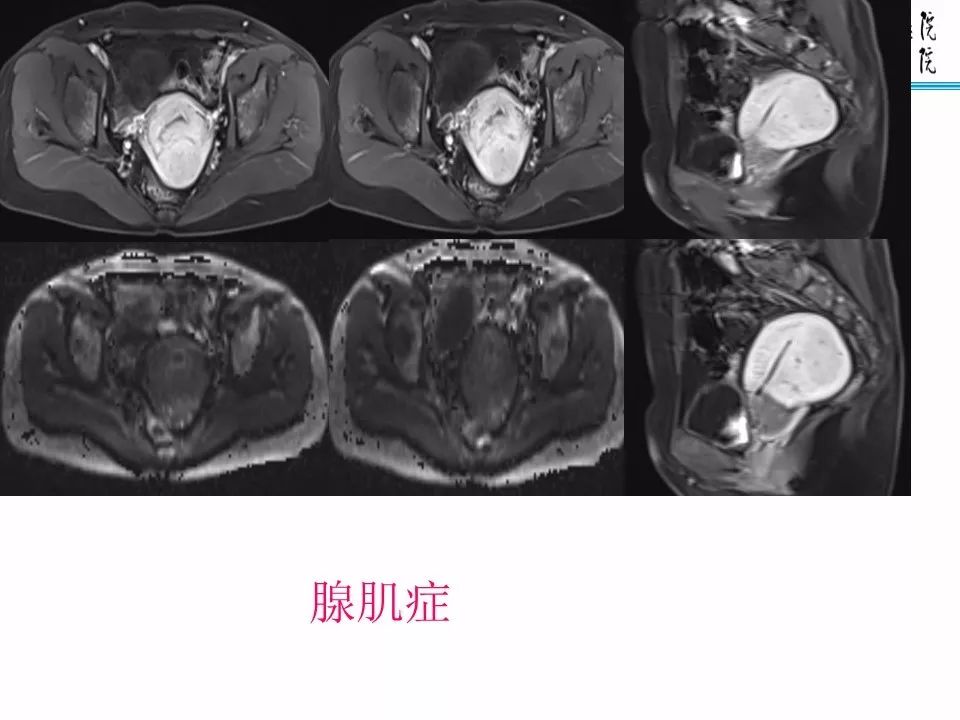 【PPT】子宫常见肿瘤的MRI表现