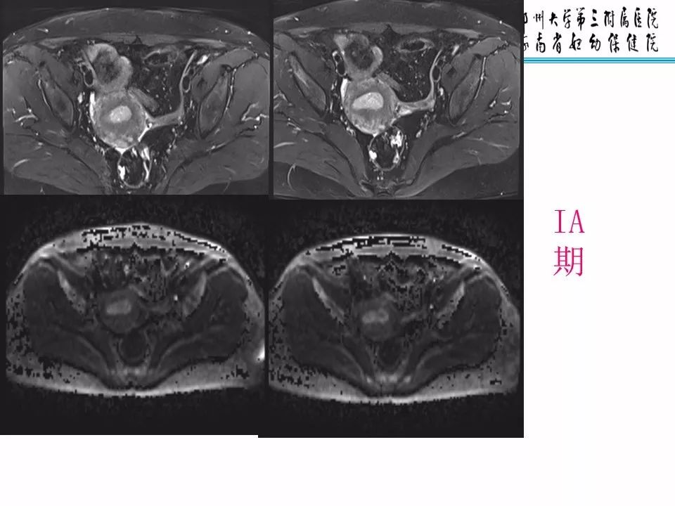 【PPT】子宫常见肿瘤的MRI表现