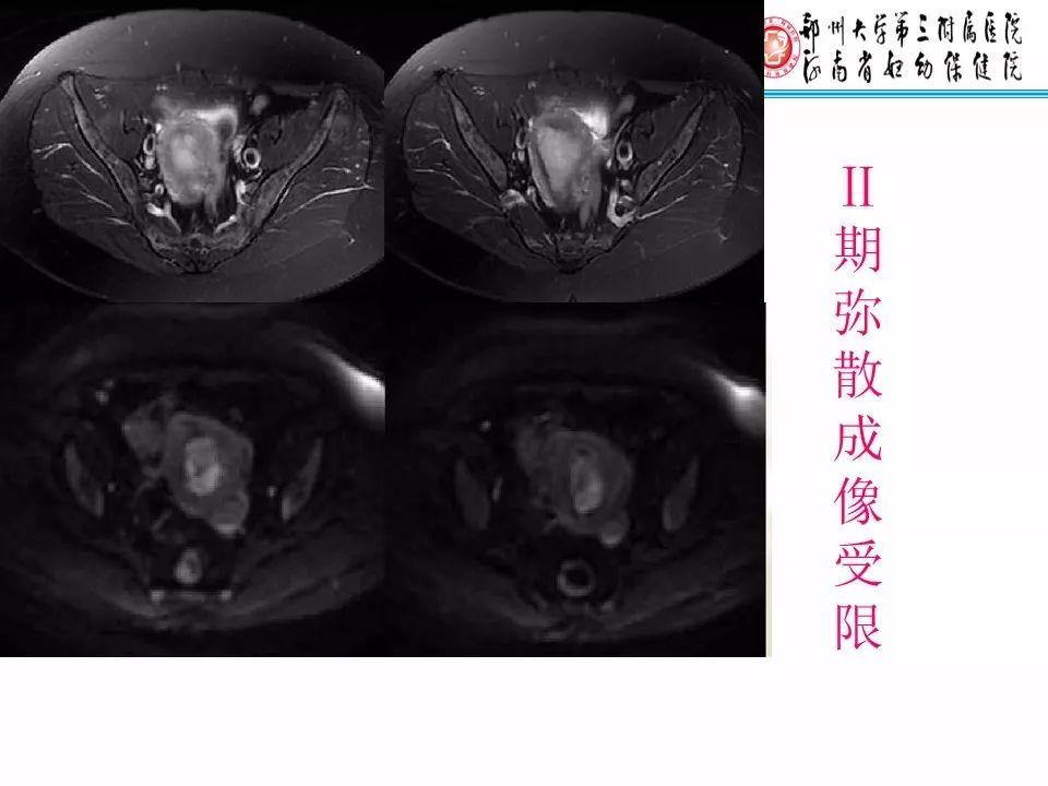 【PPT】子宫常见肿瘤的MRI表现