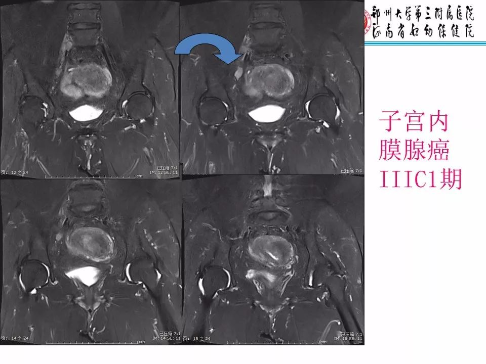 【PPT】子宫常见肿瘤的MRI表现