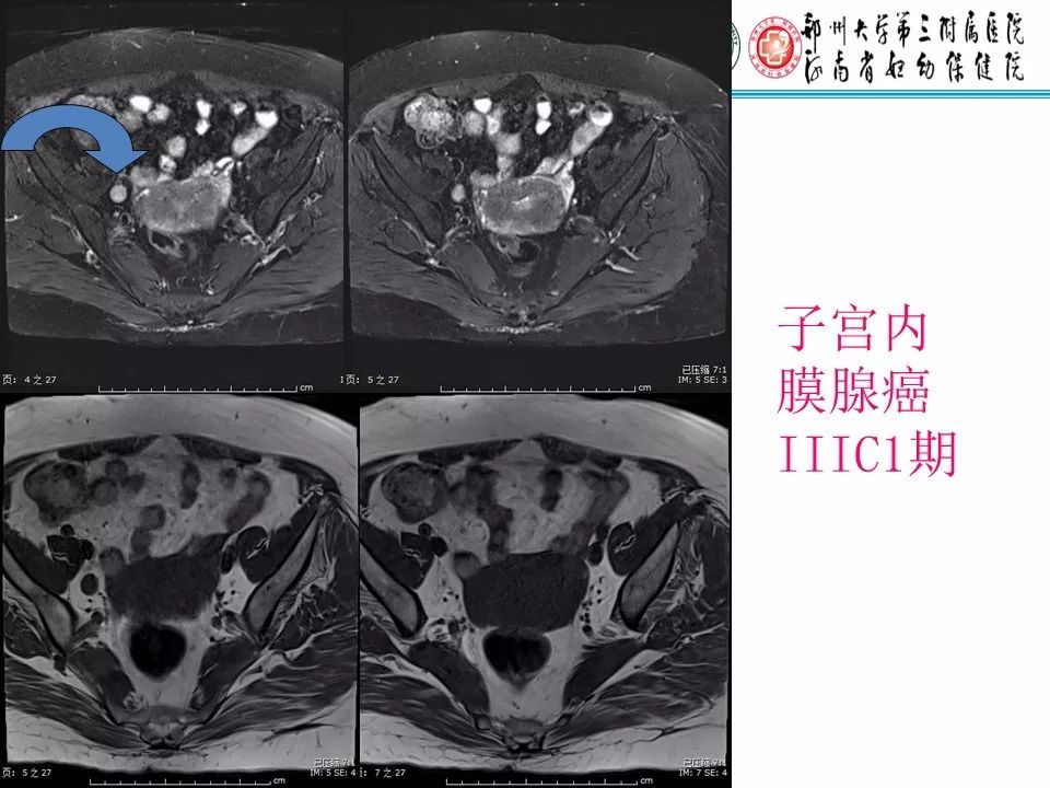 【PPT】子宫常见肿瘤的MRI表现