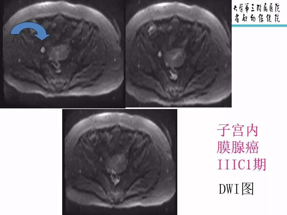 【PPT】子宫常见肿瘤的MRI表现