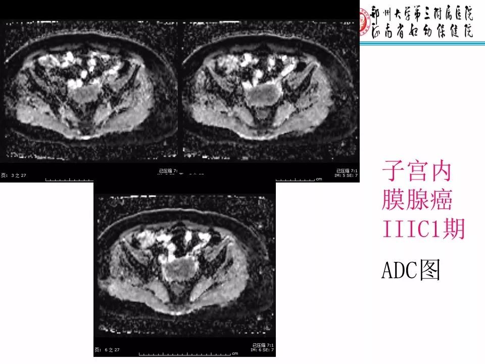 【PPT】子宫常见肿瘤的MRI表现