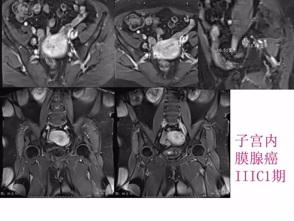 【PPT】子宫常见肿瘤的MRI表现